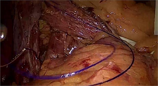 Laparoscopic camera view showing the posterior defect being repaired.