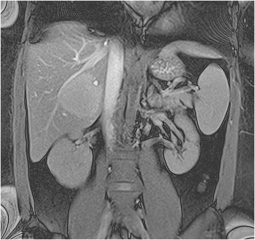 Preoperative liver MRI showing two lesions in segment V-VII of the right hepatic lobe consistent with hepatocellular adenomas.
