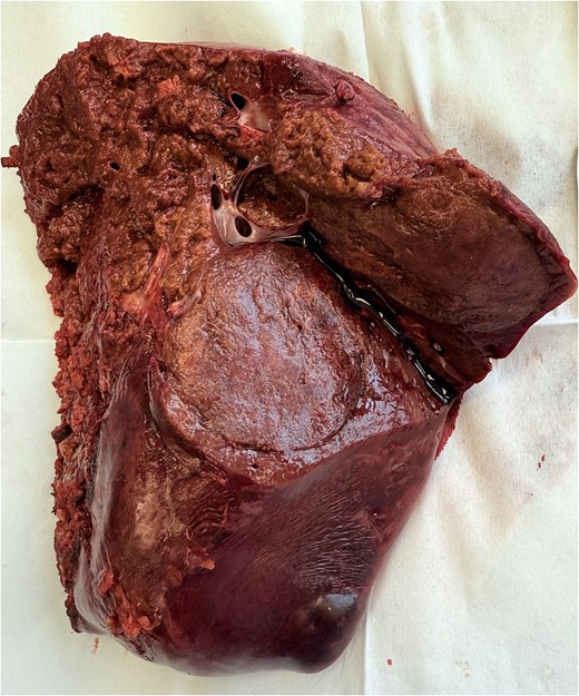 Intraoperative view after right hepatectomy demonstrating the liver transection surface.