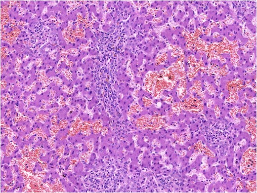 Histopathological image of hepatocellular adenoma showing features of HNF1A-inactivated and inflamatory subtypes on haematoxylin and eosin staining.