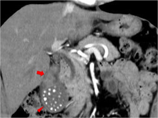 Coronal contrast-enhanced computed tomography image showing multiple calcified gallstones and localized wall thickening at the gallbladder neck.