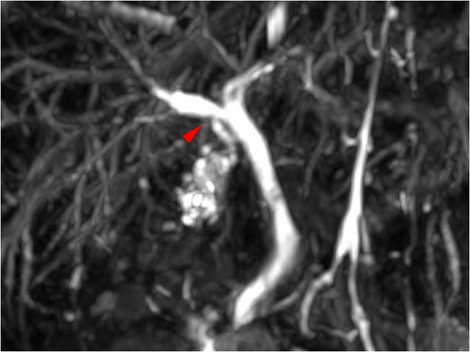 Magnetic resonance cholangiopancreatography image demonstrating anomalous drainage of the cystic duct into the right hepatic duct.
