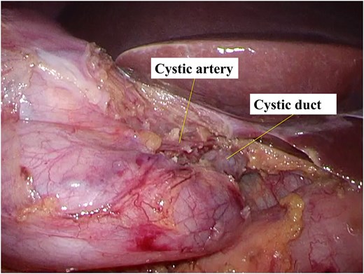 Laparoscopic image showing the gallbladder dissected to achieve the critical view of safety before cystic duct division.
