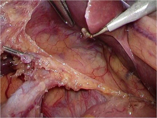 Laparoscopic image showing a cranially coursing cystic duct extending toward the hepatic hilum beneath the serosa of the hepatoduodenal ligament.