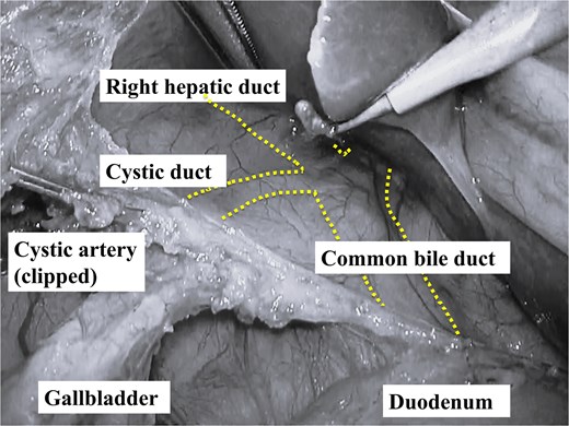Annotated schematic illustration identifying the gallbladder, cystic duct, hepatoduodenal ligament and presumed right hepatic duct.
