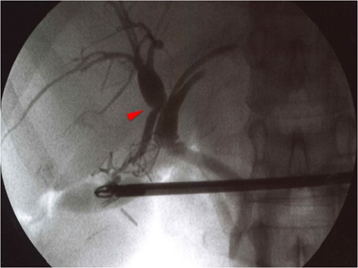 Intraoperative cholangiographic image confirming that the cystic duct enters the right hepatic duct.