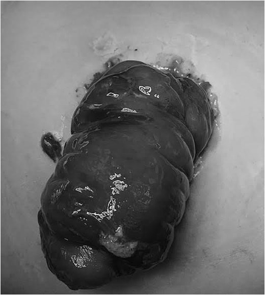 Intraoperative photograph showing a prolapsed efferent limb of a loop colostomy with partial manual reduction performed under general anesthesia prior to stapler-assisted revision.