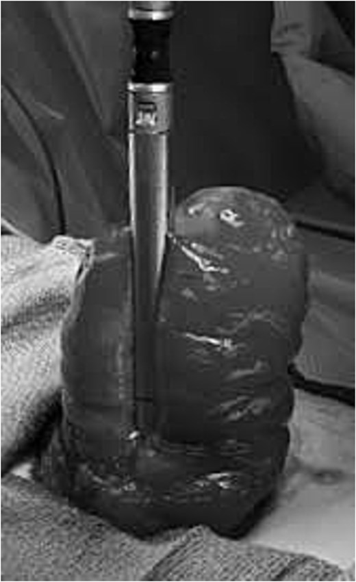 Intraoperative photograph showing initial placement of a 60 mm linear stapler across the prolapsed efferent limb of a loop colostomy at the 3 o'clock position prior to stapler-assisted revision.