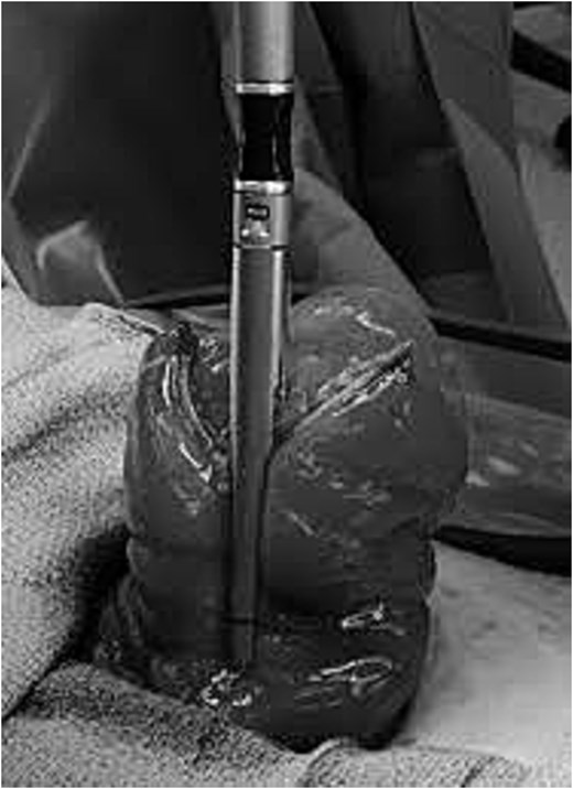 Intraoperative photograph showing sequential stapler division of the prolapsed efferent limb of a loop colostomy during extracorporeal stapler-assisted revision.