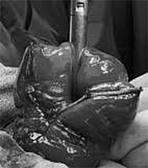 Intraoperative photograph showing continued stapler-assisted transection of the prolapsed efferent limb of a loop colostomy while preserving the remaining viable bowel.