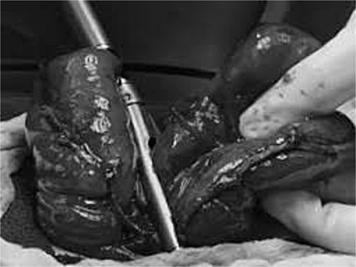 Intraoperative photograph showing completion of stapler-assisted division of the prolapsed efferent limb of a loop colostomy after successive linear stapler firings.