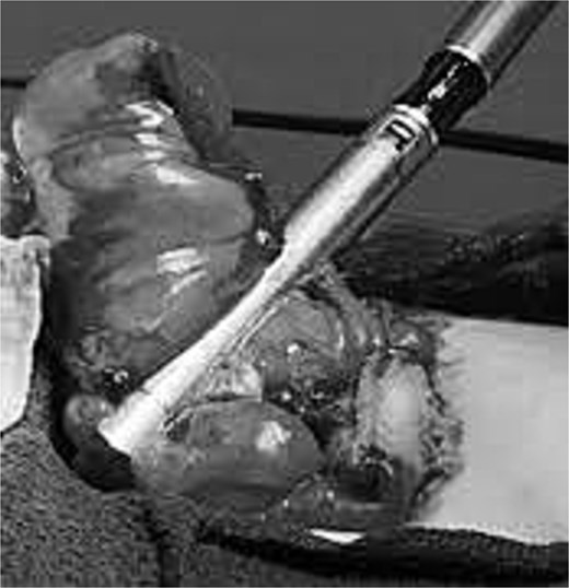Intraoperative photograph showing the final appearance of the revised loop colostomy after extracorporeal stapler-assisted resection, with a viable, reconstructed stoma.