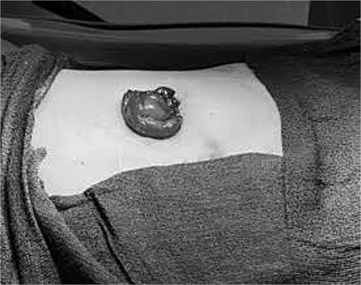 Postoperative photograph showing the revised loop colostomy after successful reduction of the prolapse and before ostomy appliance placement.