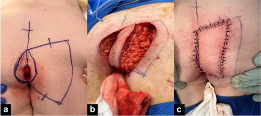 Three-panel clinical photograph demonstrating the intra-operative steps for keystone design perforator island flap reconstruction for pilonidal disease. Image a (Left) preoperative marking of the flap with pilonidal sinus visible in the midline. Image b (Centre) surgical defect following excision of sinus and mobilization of flap. Image c (Right) completed flap closure with sutures.