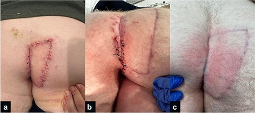 Three postoperative clinical photographs showing the healing keystone design perforator island flap. Image (a) (Left) early postoperative flap closure with minimal sutures remaining. Image (b) (Centre) inferior wound dehiscence, sutured. Image (c) (Right) healed surgical site with mature scar.