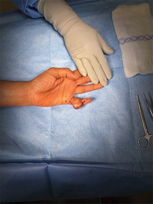 Intraoperative photograph of a patient’s hand during surgery, showing a tumor at the base of the fifth finger. A gloved clinician stabilizes the hand, with sterile draping, gauze, and surgical instruments visible in the field.