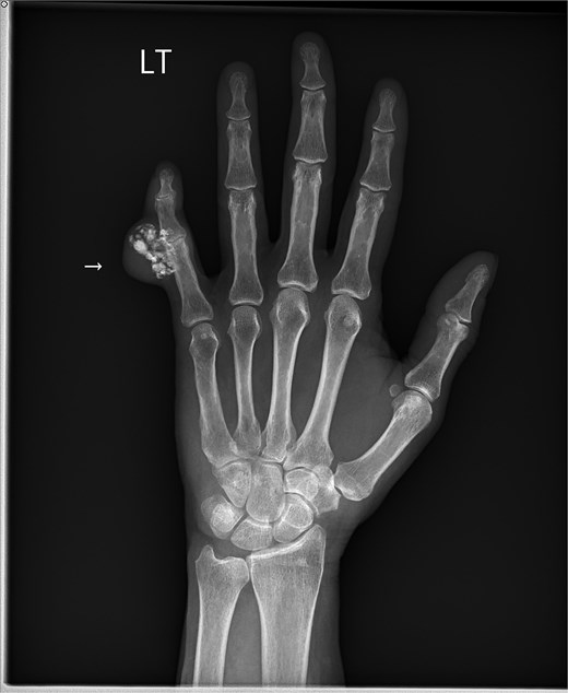 Radiograph of a left hand with an arrow indicating a calcified soft-tissue mass adjacent to the proximal phalanx of the little finger; underlying bone alignment and joint structures are preserved.