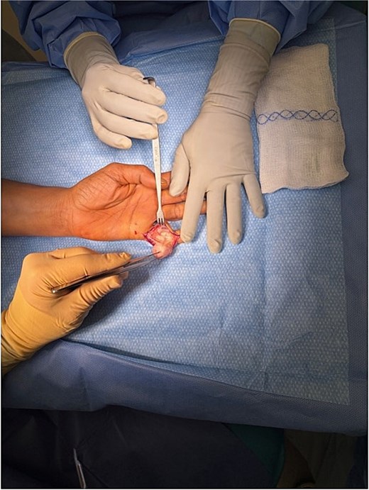 Intraoperative photograph of a patient’s hand showing surgical dissection of a tumor of the fifth finger; gloved clinicians use forceps and a retractor to separate the mass from surrounding tissue, with sterile drapes and gauze visible.
