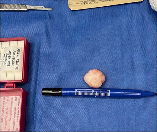 Intraoperative photograph of a well-circumscribed excised tumor placed next to a ruler.