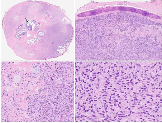 Four slides are shown. The left upper slide is a low-power hematoxylin and eosin–stained section showing a well-circumscribed lesion composed predominantly of eosinophilic stroma with multiple cystic spaces; an arrow highlights one of the larger cystic areas, which represents degenerative ossification. The right upper slide is also stained with hematoxylin and eosin, showing a purple curved rim, representing bone, with a dense collection of cells with purple nuclei directly beneath it, representing the tumor. The left lower slide is medium-power and stained with hematoxylin and eosin. This slide shows the transition from left to right, the left side of the image shows ample pink eosinophilic material with few purple nuclei and the right side depicts a high density of cells, with purple basophilic nuclei, that represent the tumor. The right lower slide is a high-power histologic slide stained with hematoxylin and eosin, showing closely packed cells with small oval purple nuclei separated by thin fibrous stroma. The cells have moderate amounts of pale pink eosinophilic cytoplasm.