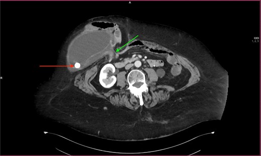 A transverse computed tomography scan showing PSH of the entire gallbladder containing gallstones.