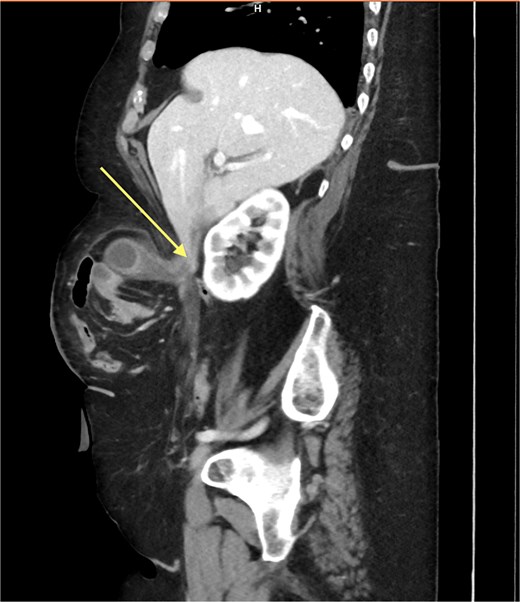 A sagittal computed tomography scan showing the herniation of the gallbladder and highlighting the elongated mesentery of the gallbladder.