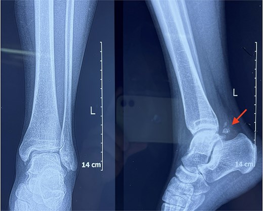 Lateral weight-bearing radiograph of the right ankle revealing multiple bony fragments located posterior to the talus.
