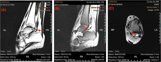 Preoperative MRI of the right ankle displaying a fragmented os trigonum posterior to the talus, accompanied by bone marrow oedema, reactive soft-tissue inflammation, and fluid surrounding the flexor hallucis longus tendon sheath.