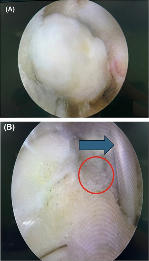 Intraoperative endoscopic images of the posterior right ankle. The first view shows an osseous fragment before excision. The second view shows a smooth posterior talar contour after complete fragment removal, with the intact FHL tendon visible as the medial anatomic landmark.