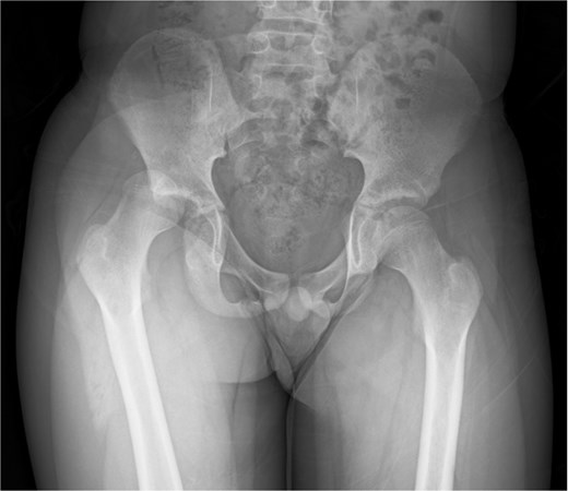 Anterior--posterior pelvic radiograph showing right hip dislocation, with the femoral head displaced from the acetabulum and loss of normal joint alignment.