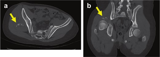 Computed tomography images of the pelvis in axial and coronal views showing right hip dislocation, with a small avulsed bone fragment adjacent to the posterior acetabular wall indicated by arrows.