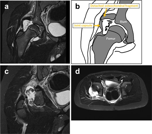 Magnetic resonance of the hip with a schematic diagram showing an osteochondral fragment at the posterior acetabular wall continuous with the labrum, with surrounding joint effusion and soft tissue changes.