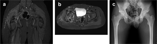 Postoperative magnetic resonance images in coronal and axial views and follow-up radiograph showing maintained reduction of the osteochondral fragment, with no residual avulsed fragment visible at 3 years.