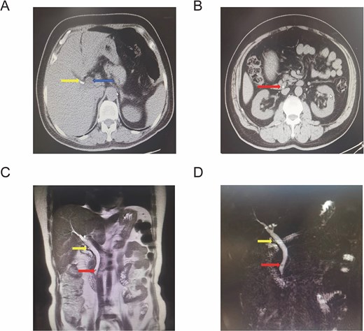 Preoperative imaging showing a cystic duct remnant with surgical clips, common bile duct dilation, and a distal common bile duct stone on CT, MRI, and MRCP.