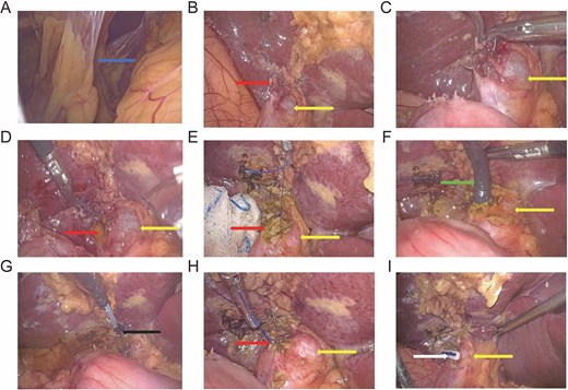 Intraoperative surgical steps of laparoscopic transcystic common bile duct exploration through a cystic duct remnant, demonstrating dissection of adhesions, identification of the cystic duct remnant, insertion of the choledochoscope, stone extraction from the common bile duct, and closure of the cystic duct remnant.