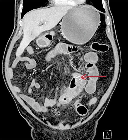 Contrast-enhanced CT scan showing gallstone ileus with pneumobilia and ectopic gallstone causing small bowel obstruction.