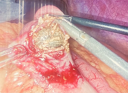 Laparoscopic view of enterotomy with extraction of an impacted gallstone from the small intestine.