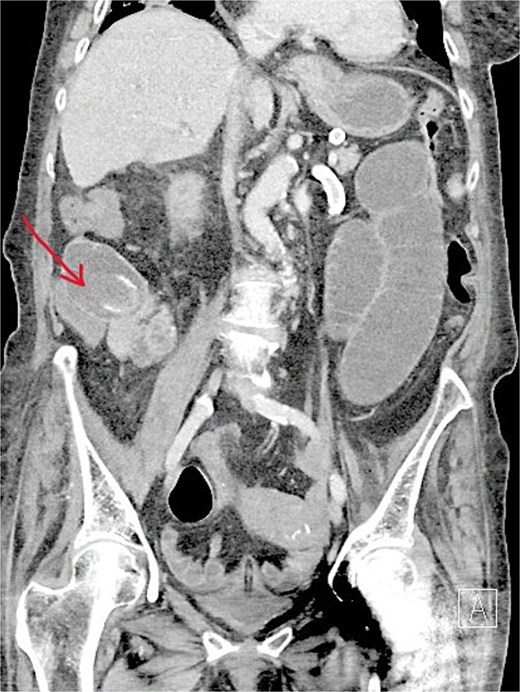 Contrast-enhanced CT scan showing an ectopic gallstone impacted in proximal ileum with associated small bowel obstruction.