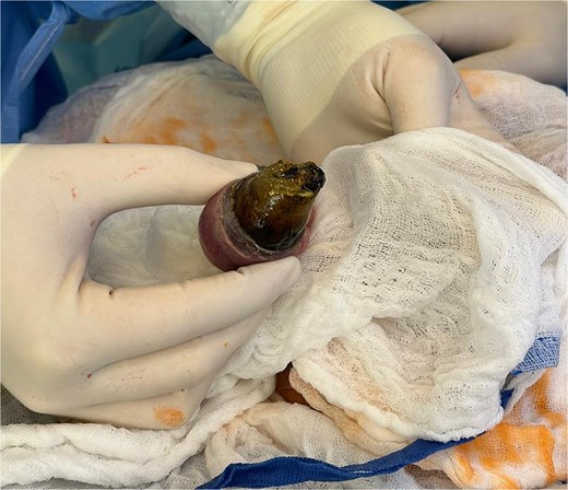 Open surgical removal of a gallstone through a longitudinal enterotomy.