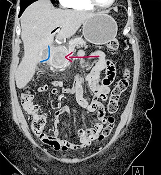 Contrast-enhanced CT scan showing a large gallstone impacted in the first part of duodenum, causing gastric outlet obstruction.