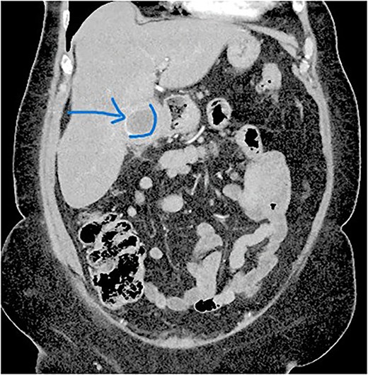 Contrast-enhanced CT scan showing a gallstone within the gallbladder and imaging features of chronic cholecystitis.