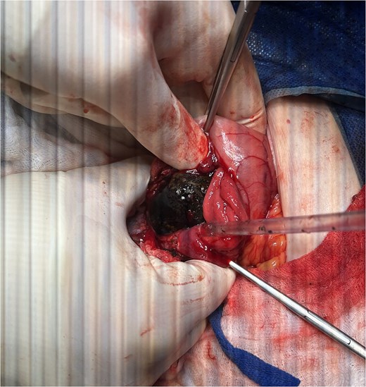 Open duodenolithotomy with extraction of a large impacted gallstone.