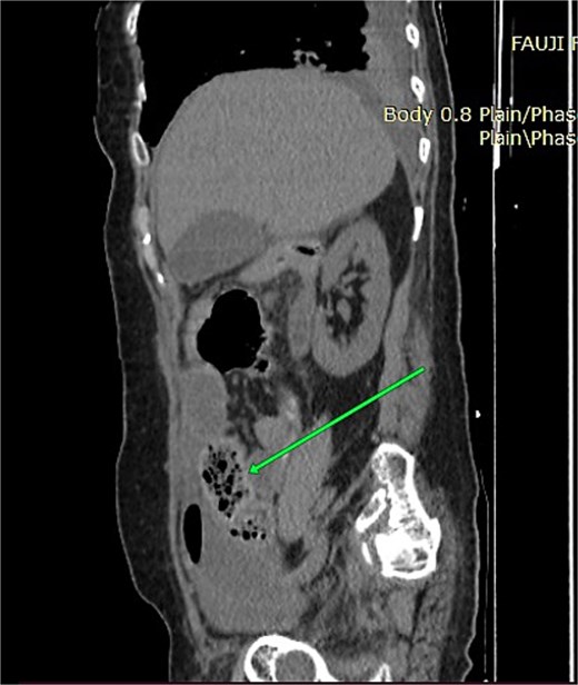 Sagittal non-contrast CT image showing dilated small bowel loops with mottled intraluminal gas consistent with the small bowel feces sign.