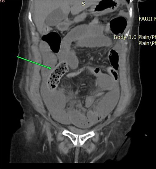 Coronal non-contrast CT image showing clustered dilated ileal loops in the lower abdomen and pelvis with narrowing toward the transition point.