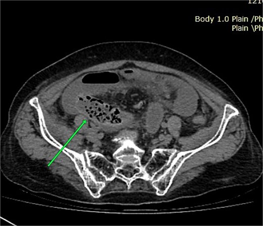 Axial non-contrast CT image showing a curved pelvic small bowel loop with twisting of adjacent mesenteric vessels at the transition point.