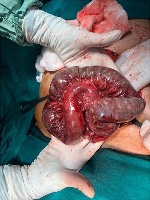 Intraoperative photograph showing a distended congested ileal loop delivered through a midline laparotomy incision.