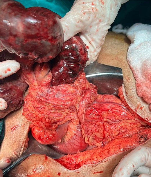 Intraoperative photograph showing gangrenous ileum adjacent to a defect in the greater omentum through which the bowel had herniated.