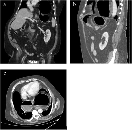CT scan of the abdomen, showing a large hiatal hernia with organoaxial gastric volvulus and pneumoperitoneum denoting gastric perforation, with extensive mesenteric fat stranding and free fluid at the gastrocolic ligament.