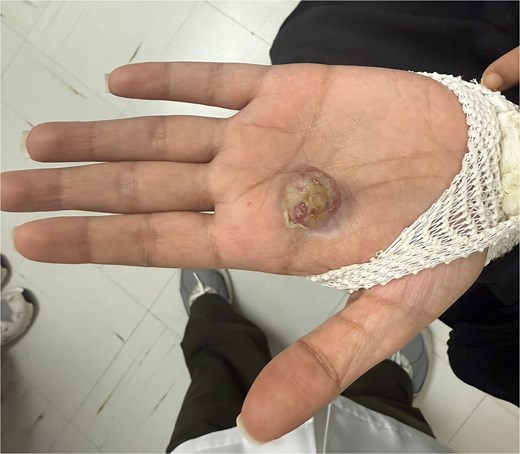 An ulcerated exophytic nodule on the palm between the second and third metacarpals, consistent with a pyogenic granuloma (lobular capillary hemangioma).