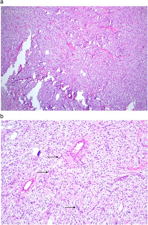 Figures showing the spindle-shaped morphology and fascicular arrangements of a soft tissue PEComa.